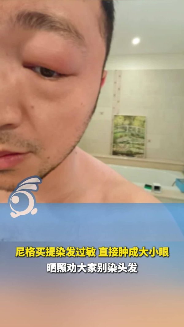 上海配资之家 尼格买提首度公开健康困扰！主持人自曝身体状况引关注，为爱美人士敲响警钟